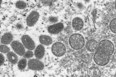 魁省25例猴痘确诊病例   最快明日起打疫苗(图)